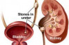 Thumbnail of Coke and Asparagus Kidney Stones Flush Remedy