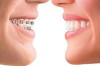 Thumbnail of Invisalign Braces Cost in the Philippines