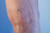 Thumbnail of How to Cure Varicose Veins Naturally