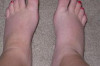 Thumbnail of How to Reduce Swelling in Feet