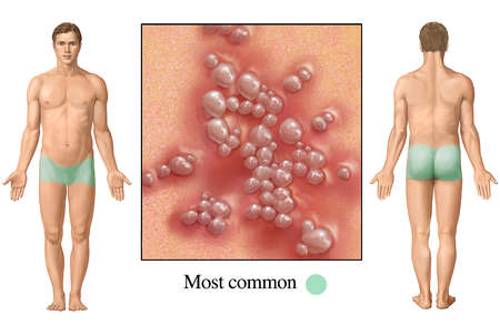 genital herpes mouth. cause of genital herpes.