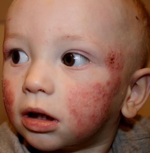 heat rash on baby. aby heat rash pictures.