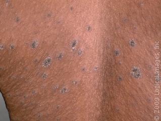 dark rash on skin