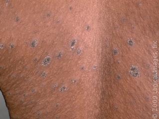 dark rash on skin