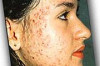 Best Medicine for Pimples / Acne Thumbnail of Best Medicine for Pimples / Acne