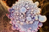 Pancreatic Cancer : How to Diagnose Thumbnail of Pancreatic Cancer : How to Diagnose