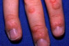 Thumbnail of How to Get Rid of Warts Naturally