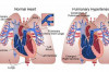 Thumbnail of Signs of Primary Pulmonary Hypertension