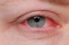 Thumbnail of How Do i Get rid of Pink Eye – Cure Conjunctivitis or Stye