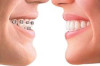 Invisalign Braces Cost in the Philippines Thumbnail of Invisalign Braces Cost in the Philippines