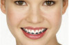 Thumbnail of Dental Braces Cost in the Philippines