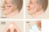 Thumbnail of How Nose Job is Done