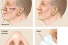 How Nose Job is Done Thumbnail of How Nose Job is Done