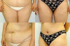 Abdominoplasty Tummy Tuck – Cost in India and Canada Thumbnail of Abdominoplasty Tummy Tuck – Cost in India and Canada