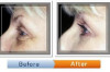 Blepharoplasty Procedure – Meaning, Indication, Recovery Time, Cost in Philippines Thumbnail of Blepharoplasty Procedure – Meaning, Indication, Recovery Time, Cost in Philippines