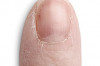 Thumbnail of Nail Products for Peeling Nails