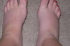 How to Reduce Swelling in Feet Thumbnail of How to Reduce Swelling in Feet