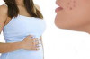 Thumbnail of How to Treat Acne During Pregnancy