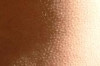 How to Treat Chicken Skin or Keratosis Pilaris Thumbnail of How to Treat Chicken Skin or Keratosis Pilaris