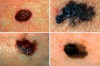 How to Get Rid of Moles on Your Face Naturally Thumbnail of How to Get Rid of Moles on Your Face Naturally