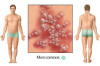 How to Know if You Have Herpes Thumbnail of How to Know if You Have Herpes