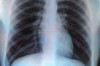 How to Cure Tuberculosis Naturally Thumbnail of How to Cure Tuberculosis Naturally