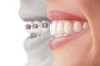 How Much do Invisalign Braces Cost in Canada Thumbnail of How Much do Invisalign Braces Cost in Canada