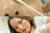 What is the Difference between Microdermabrasion and Chemical Peel? Thumbnail of What is the Difference between Microdermabrasion and Chemical Peel?