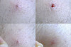 How to Prevent Ingrown Hairs after Waxing Thumbnail of How to Prevent Ingrown Hairs after Waxing