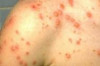 Thumbnail of How to Remove Chicken Pox Marks / Scars