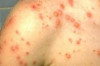 How to Remove Scars from Chicken Pox Thumbnail of How to Remove Scars from Chicken Pox