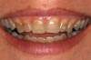Thumbnail of How to Remove Teeth Stains