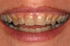 How to Remove Teeth Stains Thumbnail of How to Remove Teeth Stains