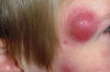 How to Treat Boils on the Face Thumbnail of How to Treat Boils on the Face