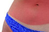 How to Treat Blister Sunburn Thumbnail of How to Treat Blister Sunburn