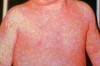 How to Treat Measles in Children Thumbnail of How to Treat Measles in Children