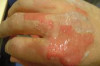 How to Treat Second and Third Degree Burns Thumbnail of How to Treat Second and Third Degree Burns