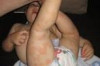 Allergy Treatment for Babies Thumbnail of Allergy Treatment for Babies