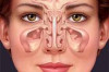 Thumbnail of Home Remedies for Sinusitis
