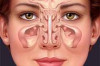 Home Remedies for Sinusitis Thumbnail of Home Remedies for Sinusitis