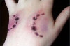 How to Treat Dog Bites Thumbnail of How to Treat Dog Bites