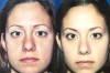 Cheek Fat Removal – Before and After Photo – Cost Thumbnail of Cheek Fat Removal – Before and After Photo – Cost