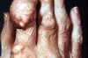 How to Prevent Gout Attacks Thumbnail of How to Prevent Gout Attacks