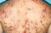 How to Prevent Pimples on Body Thumbnail of How to Prevent Pimples on Body