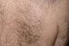How to Remove Unwanted Back Hair Thumbnail of How to Remove Unwanted Back Hair