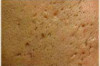 How to Treat Acne Holes Thumbnail of How to Treat Acne Holes