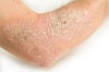 How to Treat Dry Skin Naturally Thumbnail of How to Treat Dry Skin Naturally