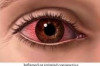 How to Treat Eye Infection Thumbnail of How to Treat Eye Infection