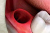 How to Avoid Dry Socket after Extraction Thumbnail of How to Avoid Dry Socket after Extraction