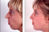 Chin Augmentation Cost / Prices in India, UK, Canada Thumbnail of Chin Augmentation Cost / Prices in India, UK, Canada
